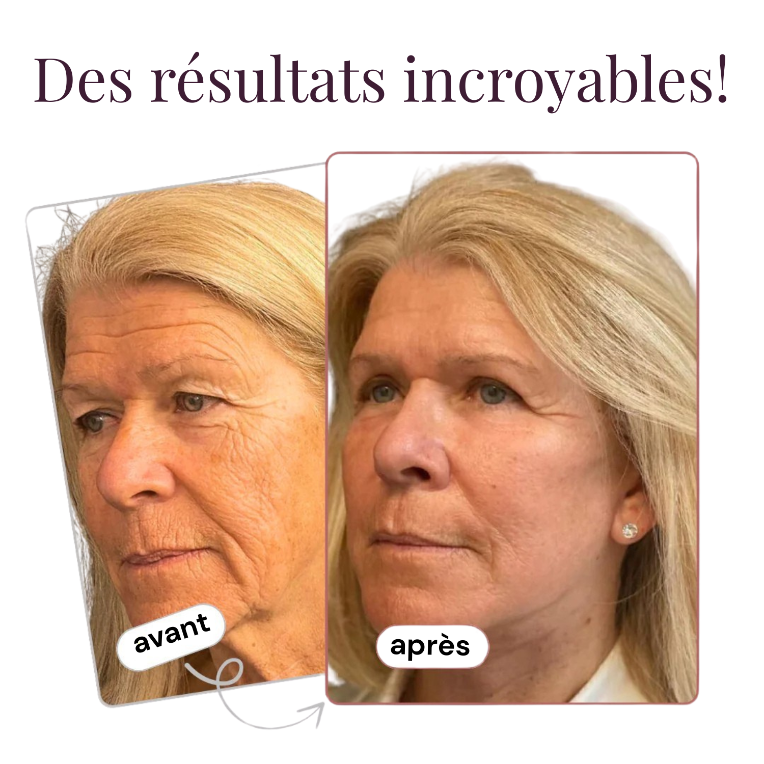 BotoxStick™ | Anti-rides au Calcium et Collagène